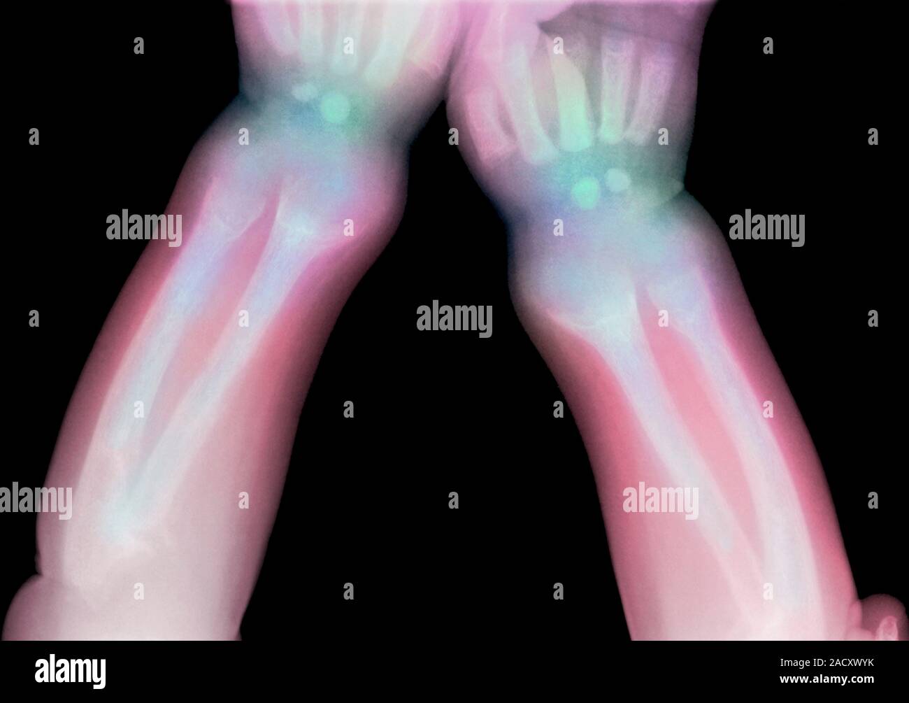 Coloured X-ray of the lower arms of a child with rickets, or ...
