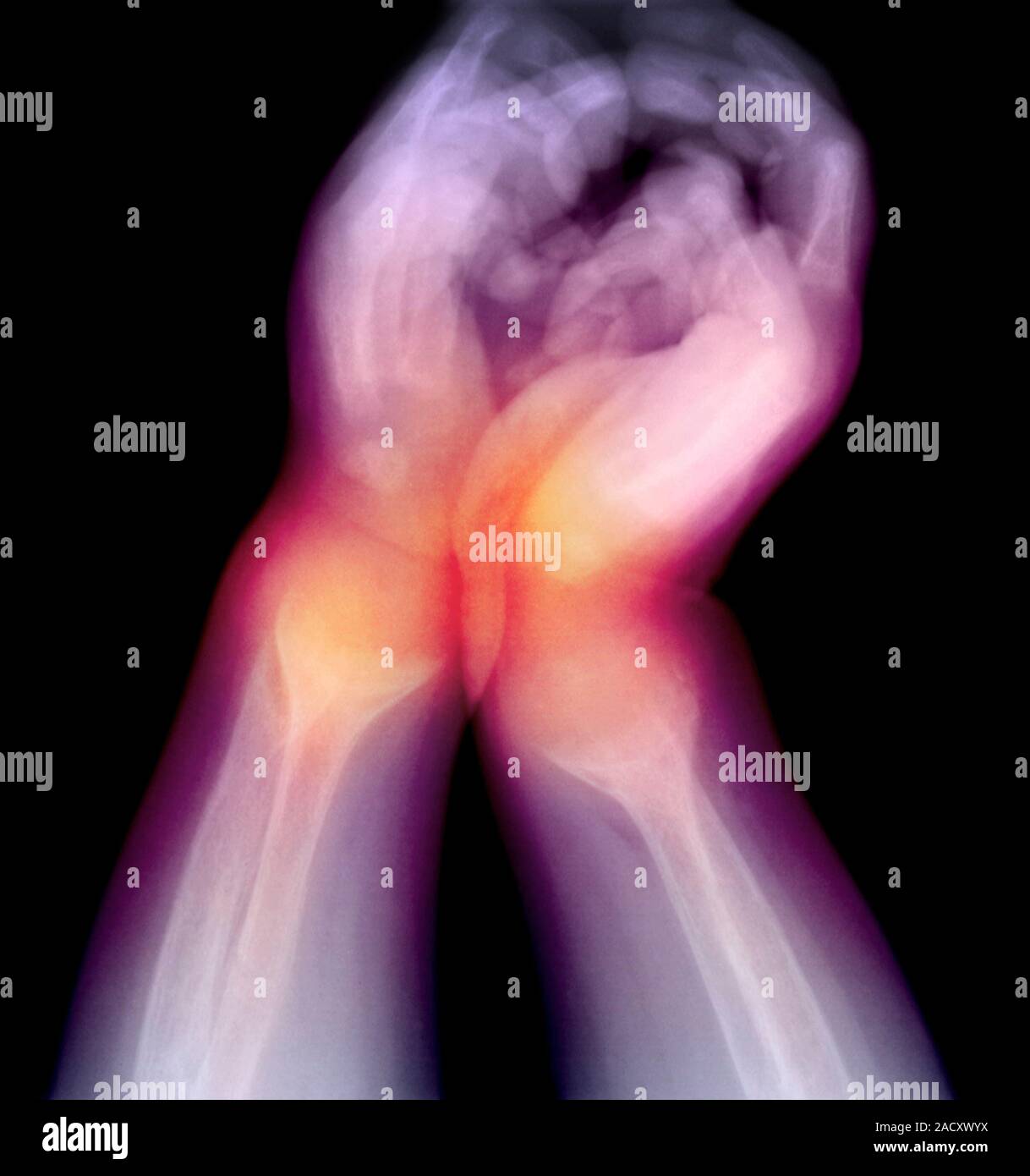 Child With Ricketa Coloured X-ray of the lower arms and hands of a child with rickets, or ...