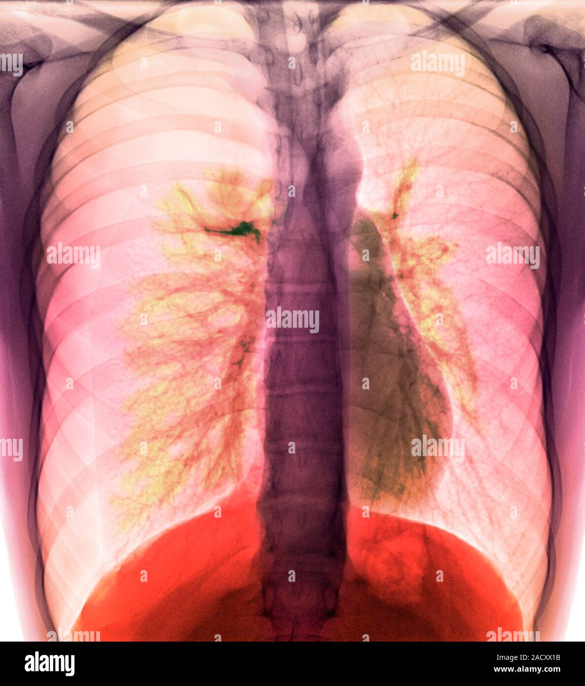 Coloured X-ray of the chest of a patient with a tension pneumothorax ...