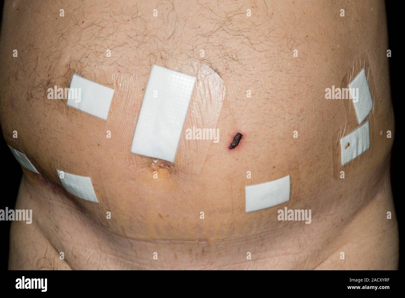 Abdomen of a patient who has undergone Da Vinci Robotic prostatectomy ...