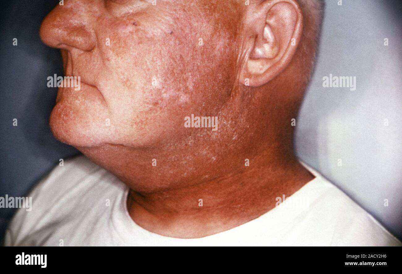 Radiation dermatitis of the face. Left side of the face and neck of a ...