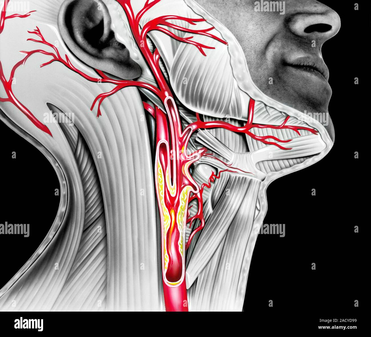 Carotid atherosclerosis. Artwork of the arteries (red) of the neck and head, showing the carotid