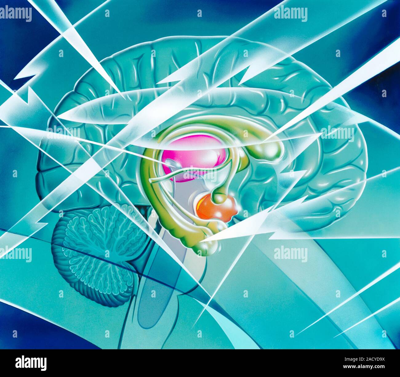 Brain in epilepsy. Artwork of lightning flashes across a side view of a