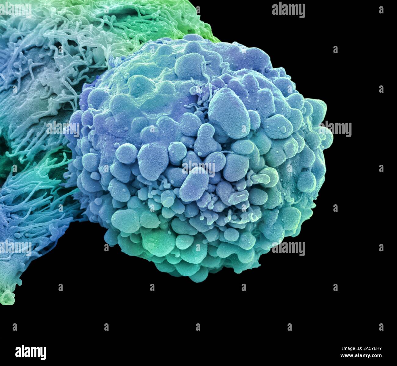 Brain cancer cell. Coloured scanning electron micrograph (SEM) of a ...