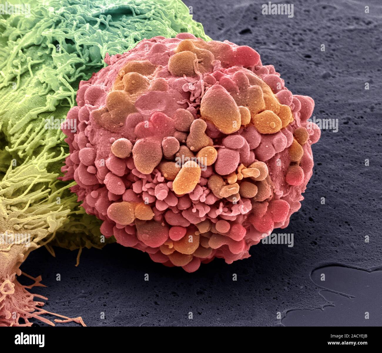 Brain cancer cell. Coloured scanning electron micrograph (SEM) of a ...