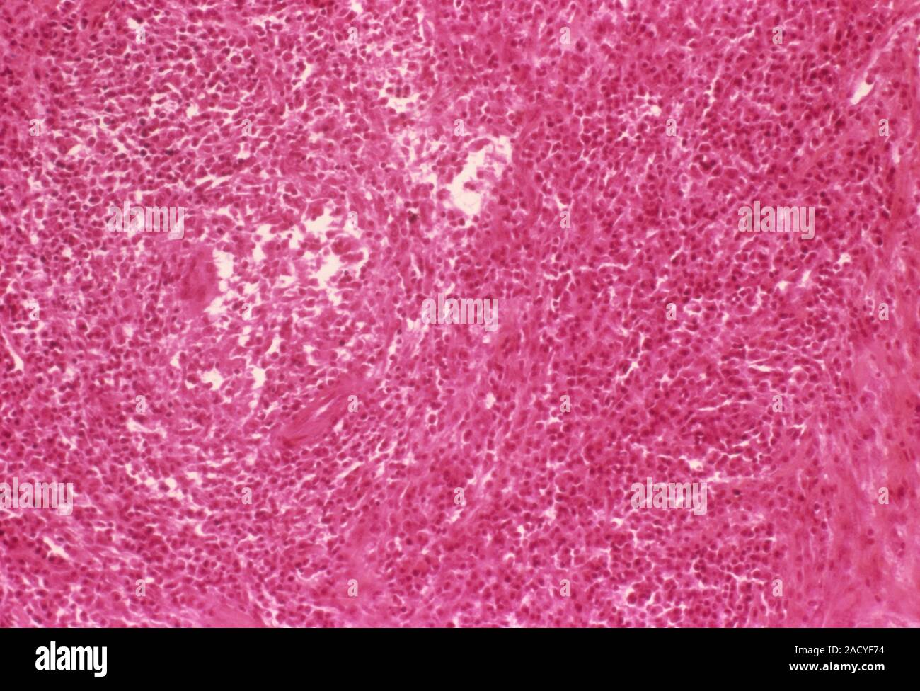 Crohn's disease. Light micrograph of a section through a small intestine affected by Crohn's