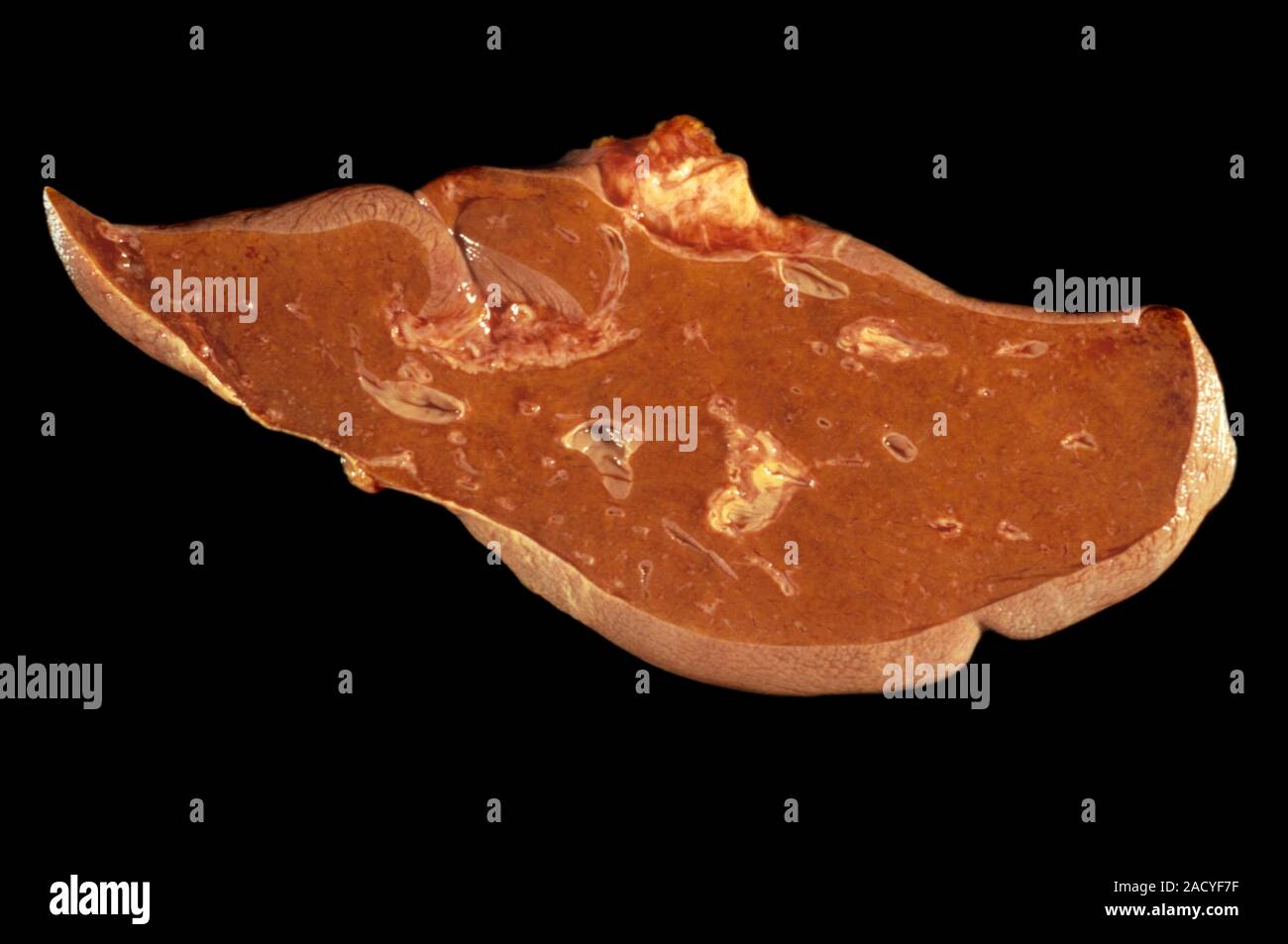 Fulminant hepatitis. Liver affected by fulminant hepatitis. Hepatitis
