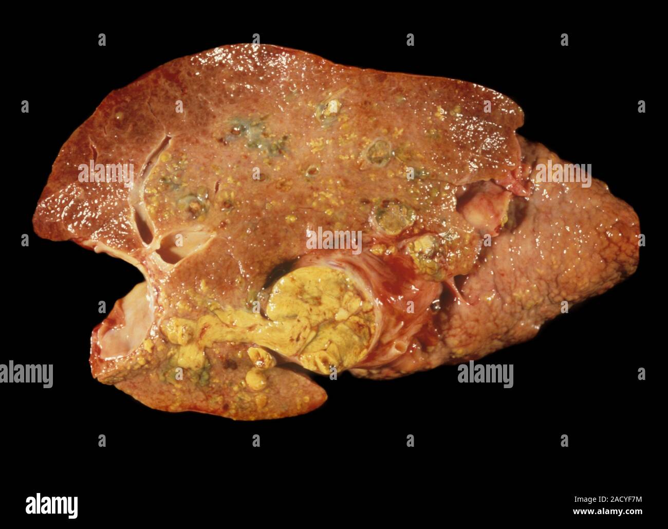 Liver Cancer Section Through A Liver Affected By Hepatocellular