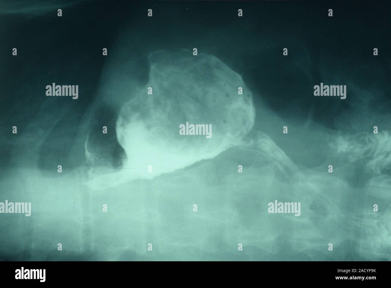 Stomach cancer. Xray of a patient who has undergone surgery to remove