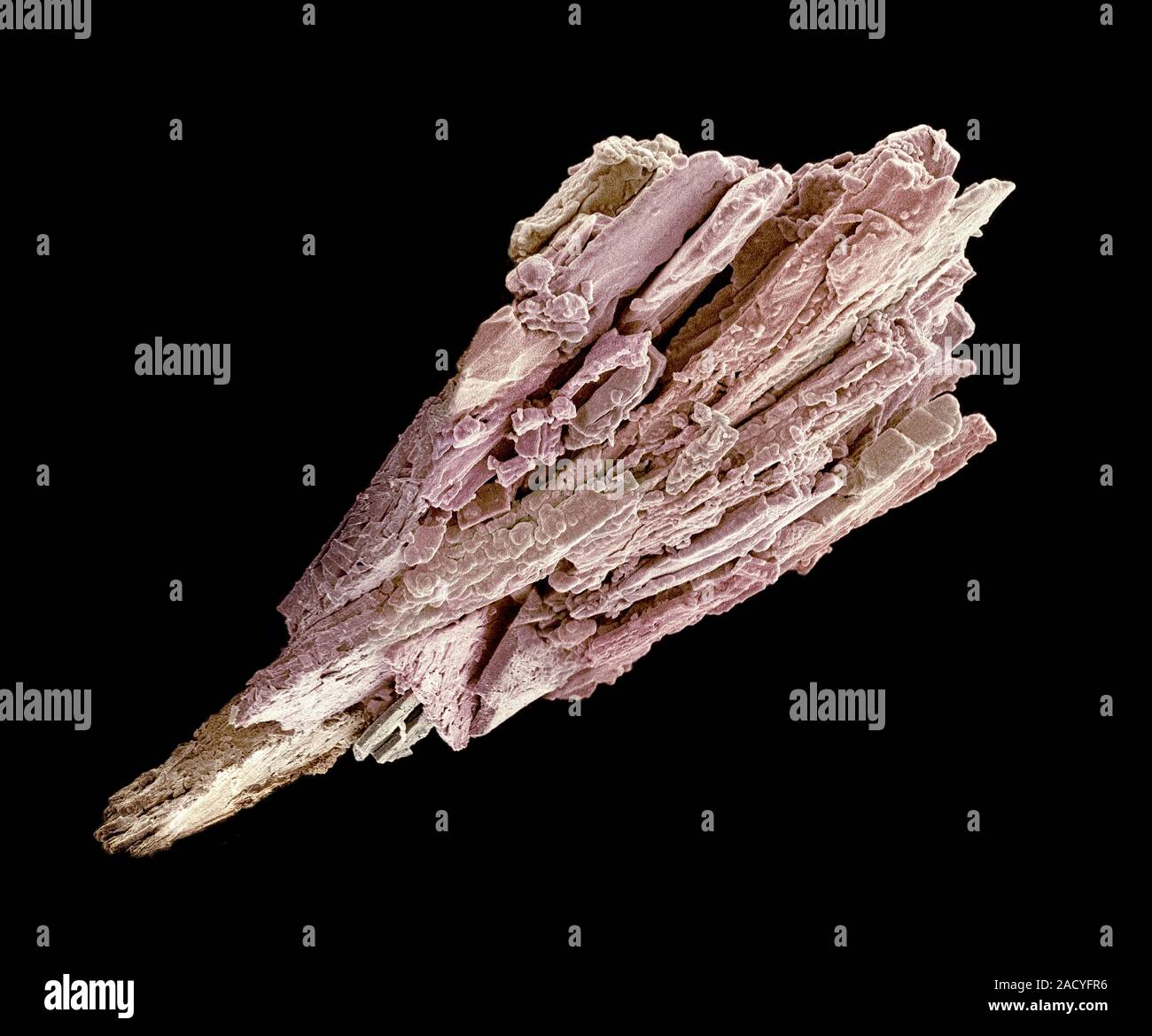 Kidney stone. Coloured scanning electron micrograph (SEM) of the