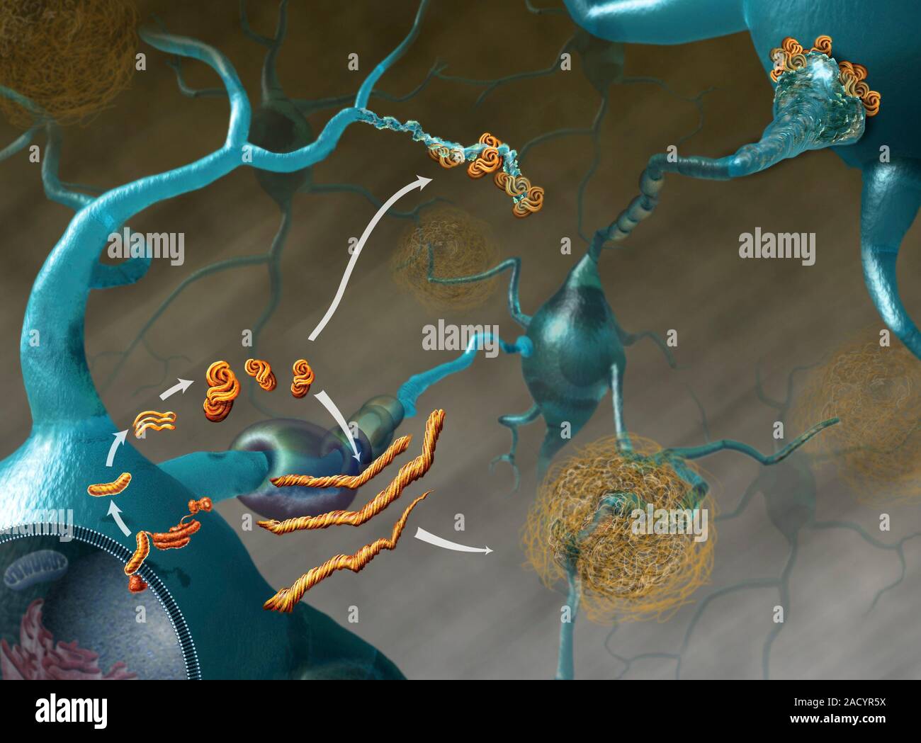 Prions in brain disease. Illustration of tangles of malformed proteins ...