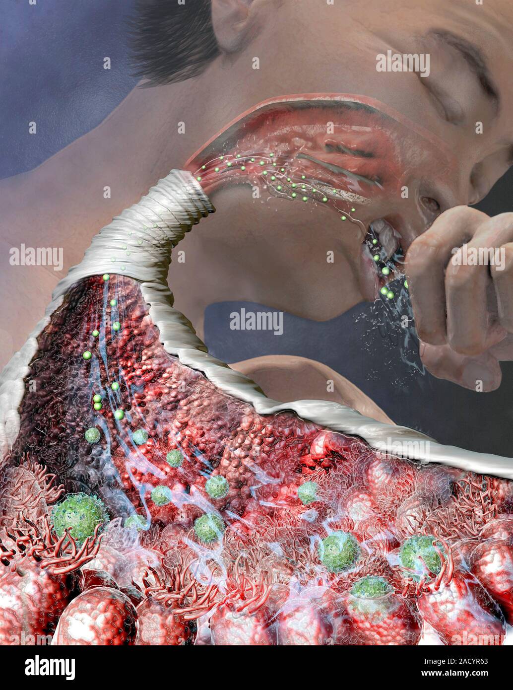 Causes of a cough. Cutaway illustration of the internal body mechanisms involved in coughing