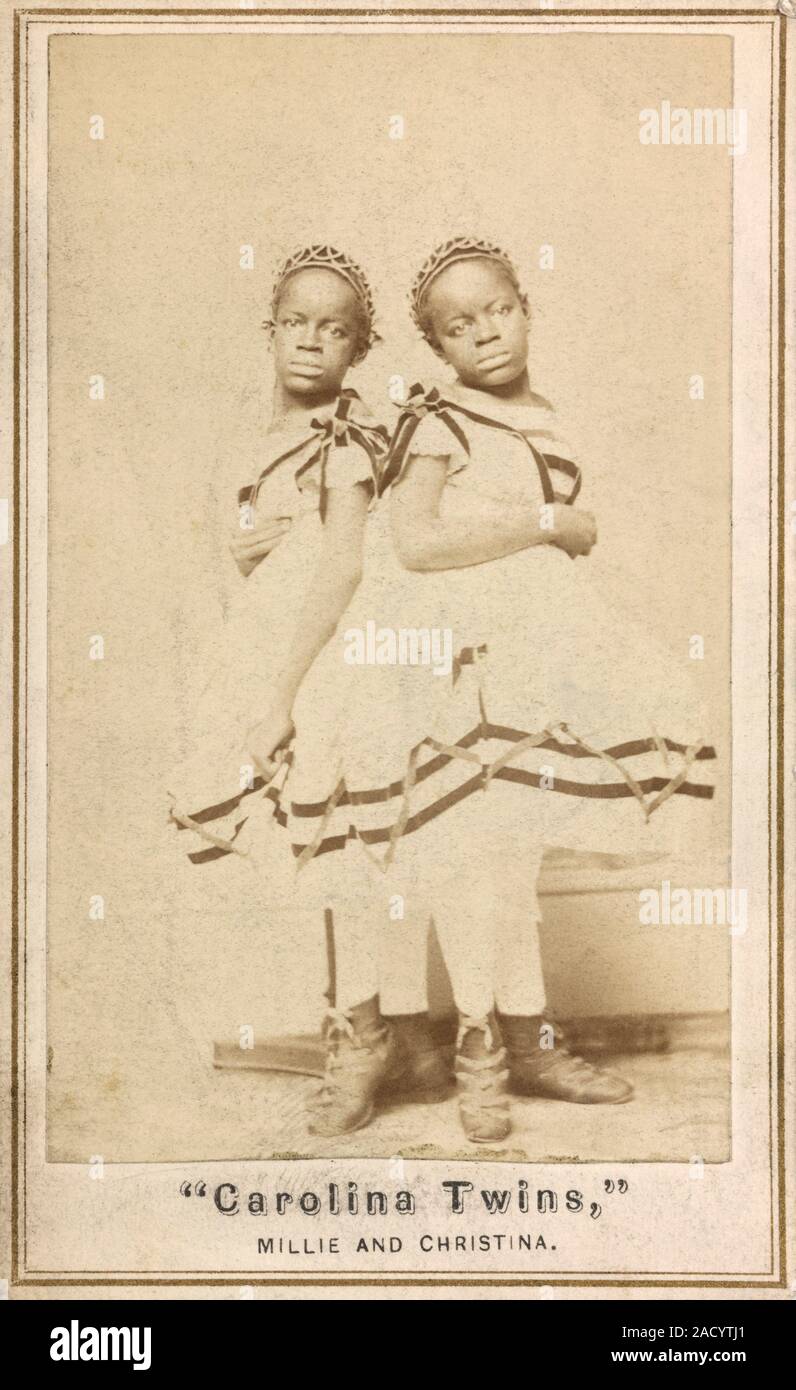 Conjoined twins. Carte de visite mounted albumen photographic print of