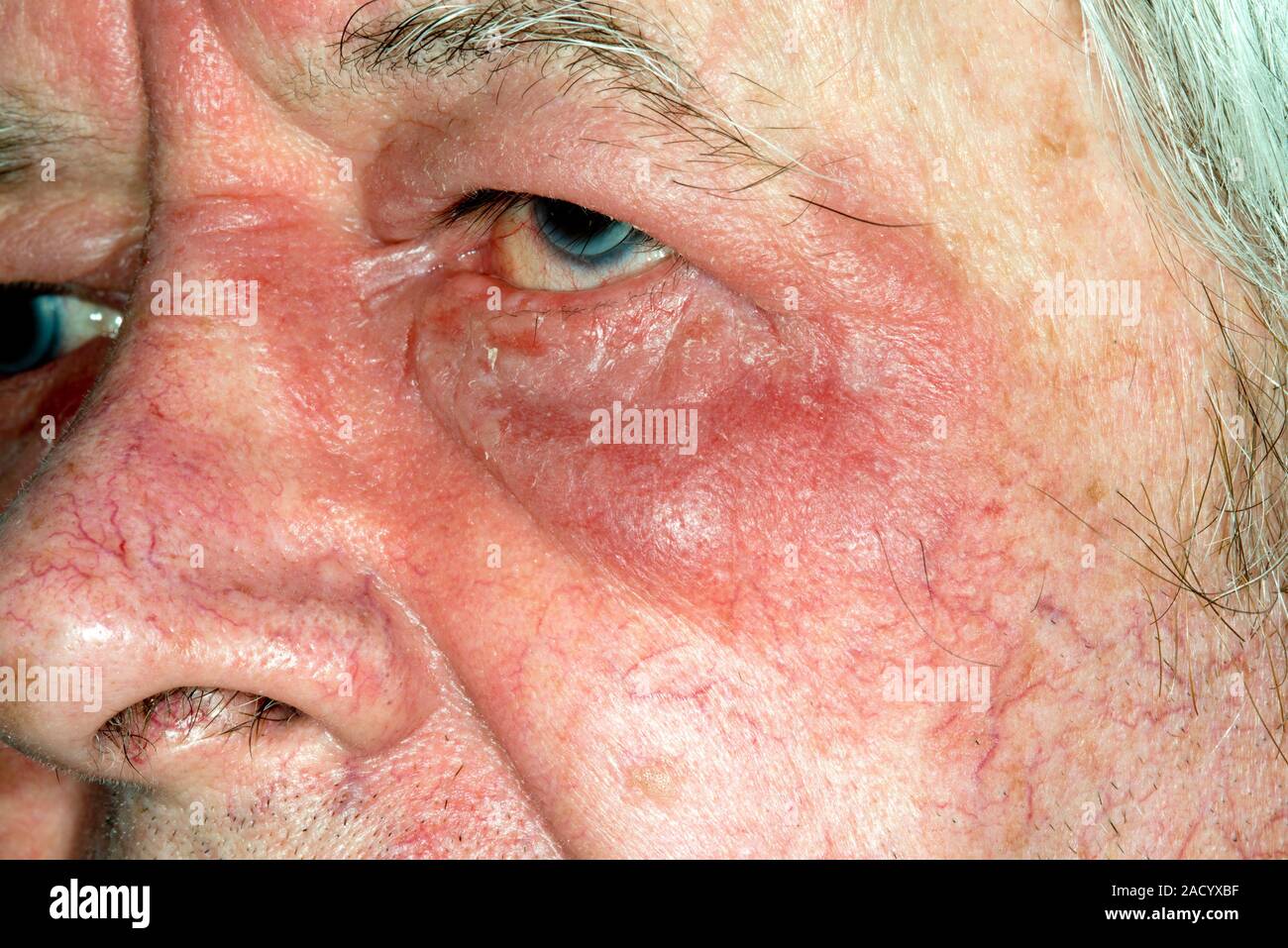 Eczema around the eye. Closeup of the face of an 81yearold male