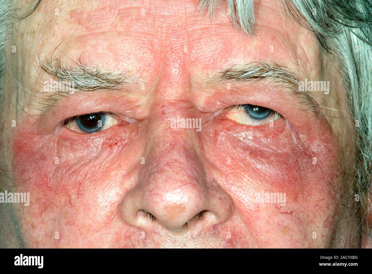 Eczema around the eye. Closeup of the face of an 81yearold male