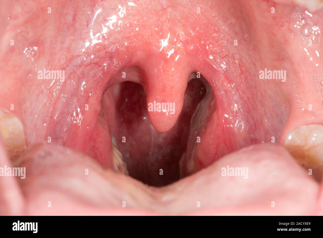 Throat In Glandular Fever Close up Of The Inflamed Tonsils Of A 23 throat-in-glandular-fever-close-up-of-the-inflamed-tonsils-of-a-23
