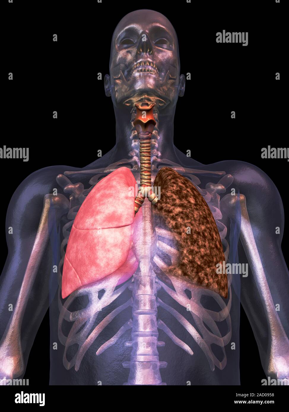 The effects on smoking on lung tissue . Computer illustration of the ...