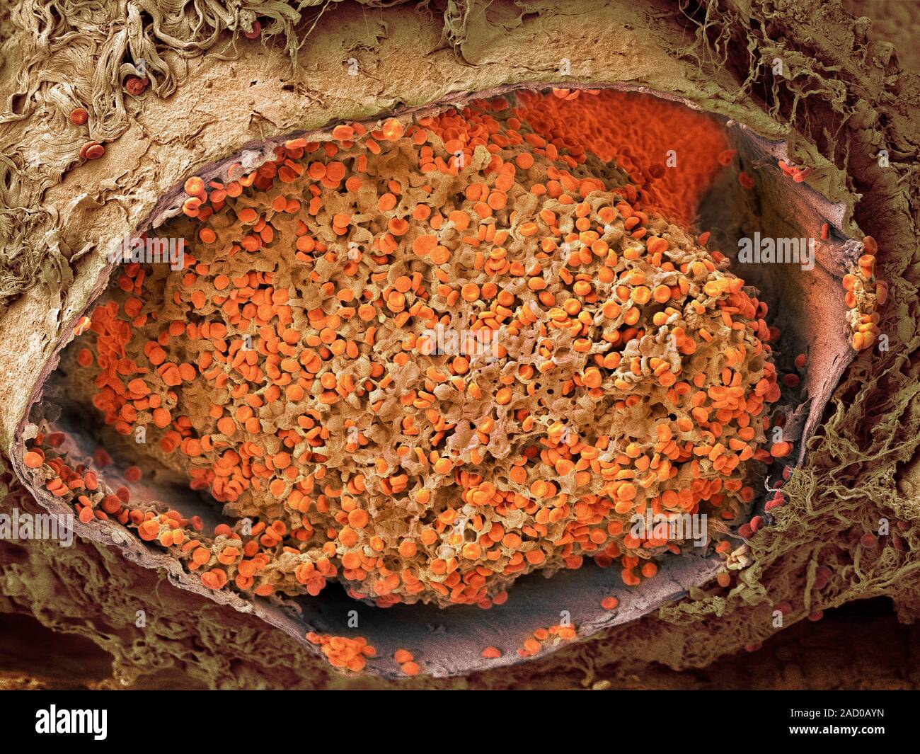 Blood clot in the lung. Coloured scanning electron micrograph of a