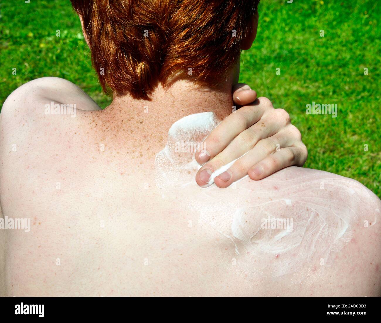Sunscreen lotion for freckled skin. 18-year-old red-haired young man applying sunscreen lotion to the skin of his neck and shoulders. The freckled ski Stock Photo