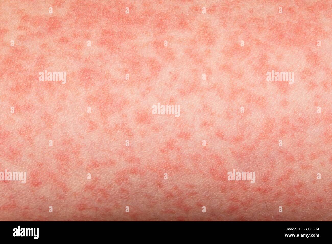 Scarlet Fever Close up Of A Rash On The Skin Of A 15 year old Female Scarlet Fever Close up Of A Rash On The Skin Of A 15 year old Female