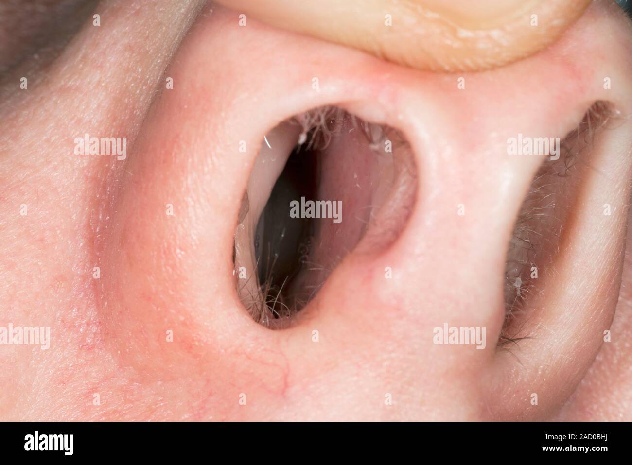 Nasal polyps. Close-up of the nose of a 40-year-old female patient with  nasal polyps. Polyps are benign growths that project on a stalk from mucous  me Stock Photo - Alamy, image size:1300x957
