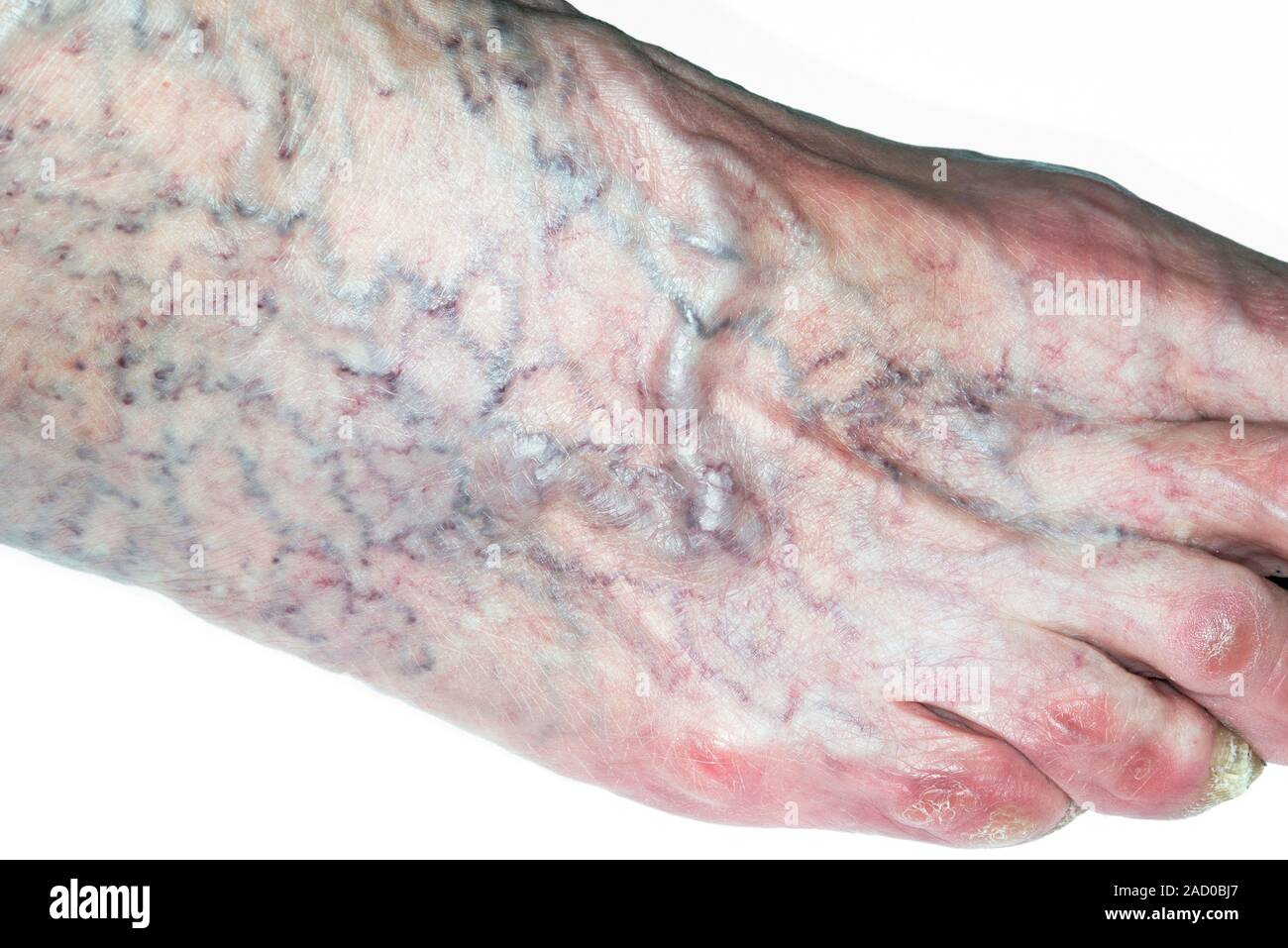 Varicose veins. Close-up of varicose veins on the foot of a 77-year-old ...
