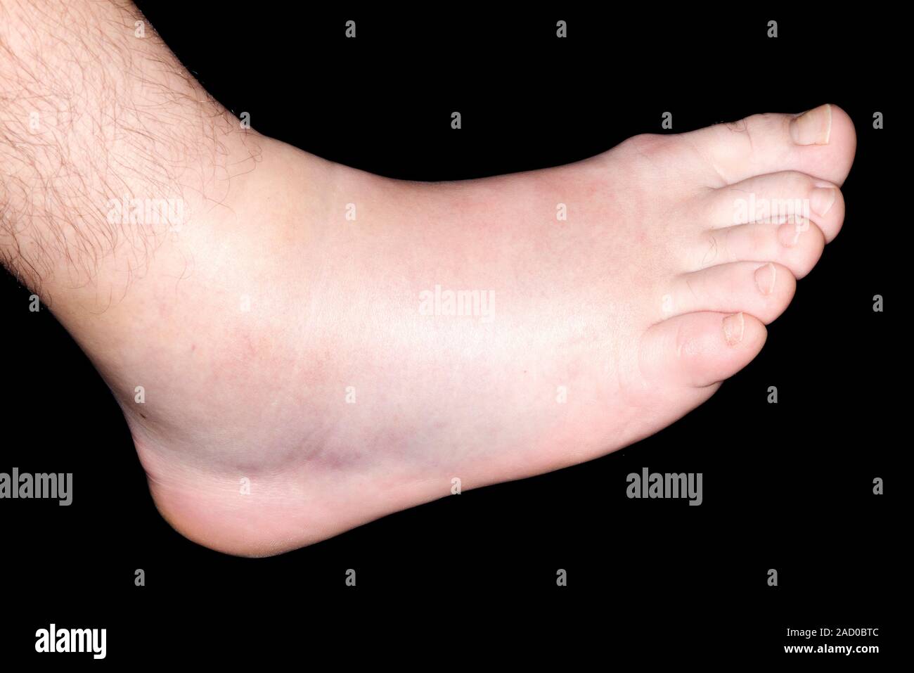 Sprained ankle. Closeup of the swollen ankle of a 39yearold female
