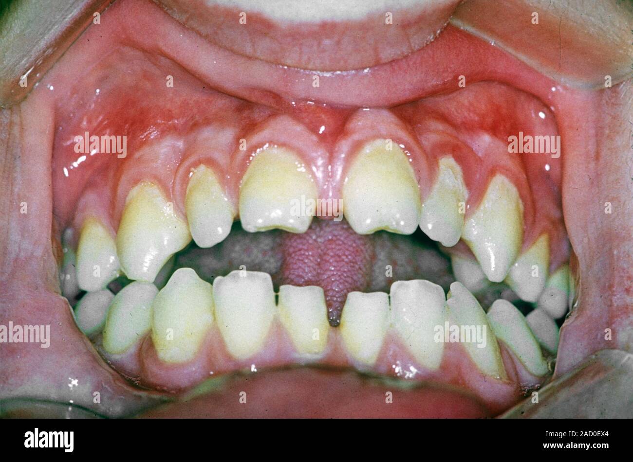 Hutchinson's teeth. Closeup of the teeth of a patient with Hutchinson