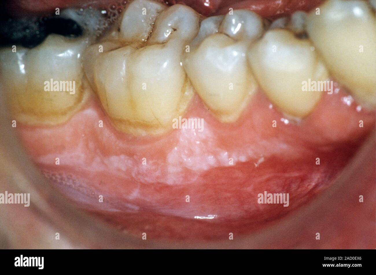 Leukoplakia of the gums. Closeup of the mouth of a patient showing