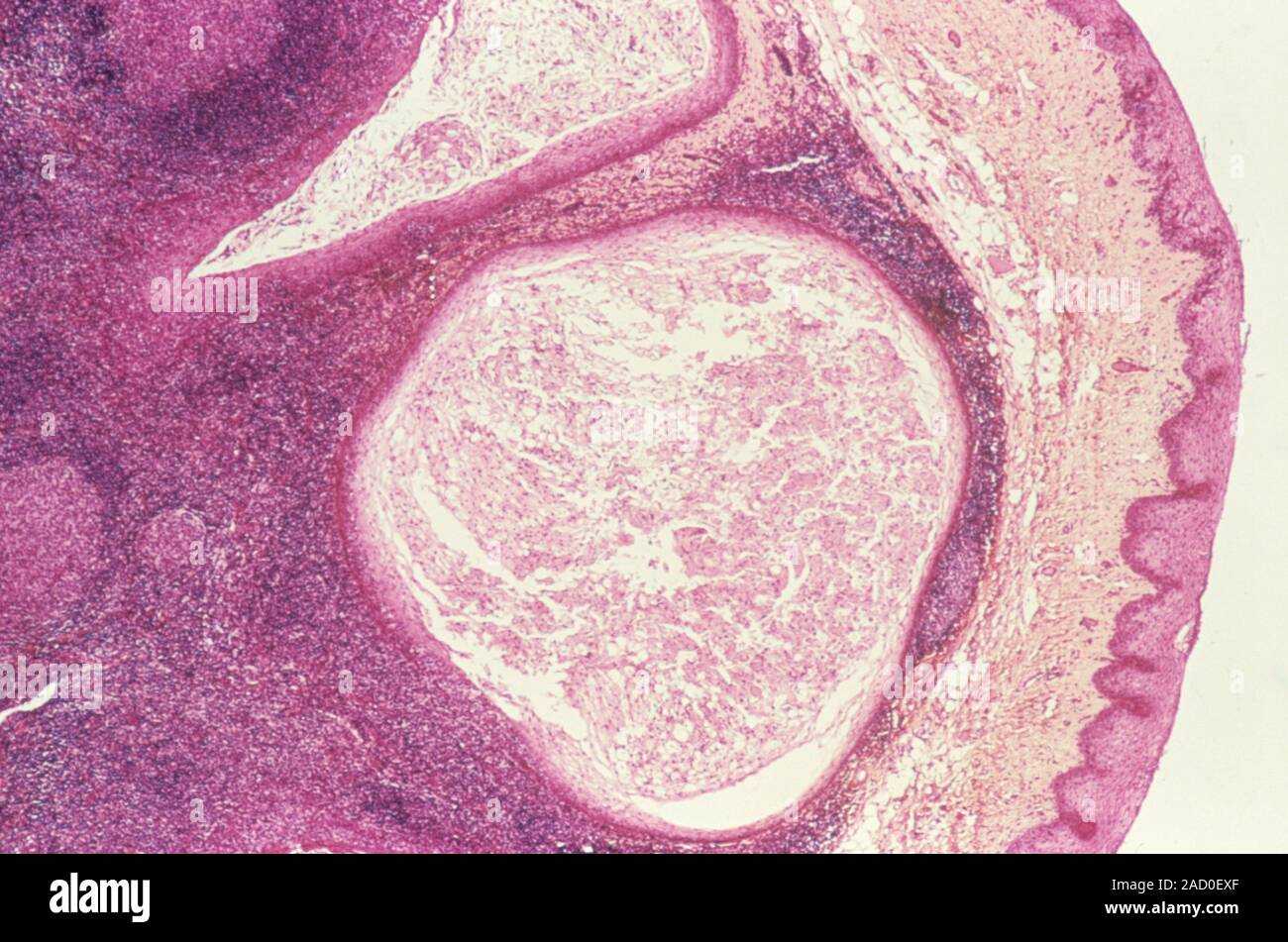 Oral Cyst Light Micrograph Of A Section Through An Epidermoid Cyst