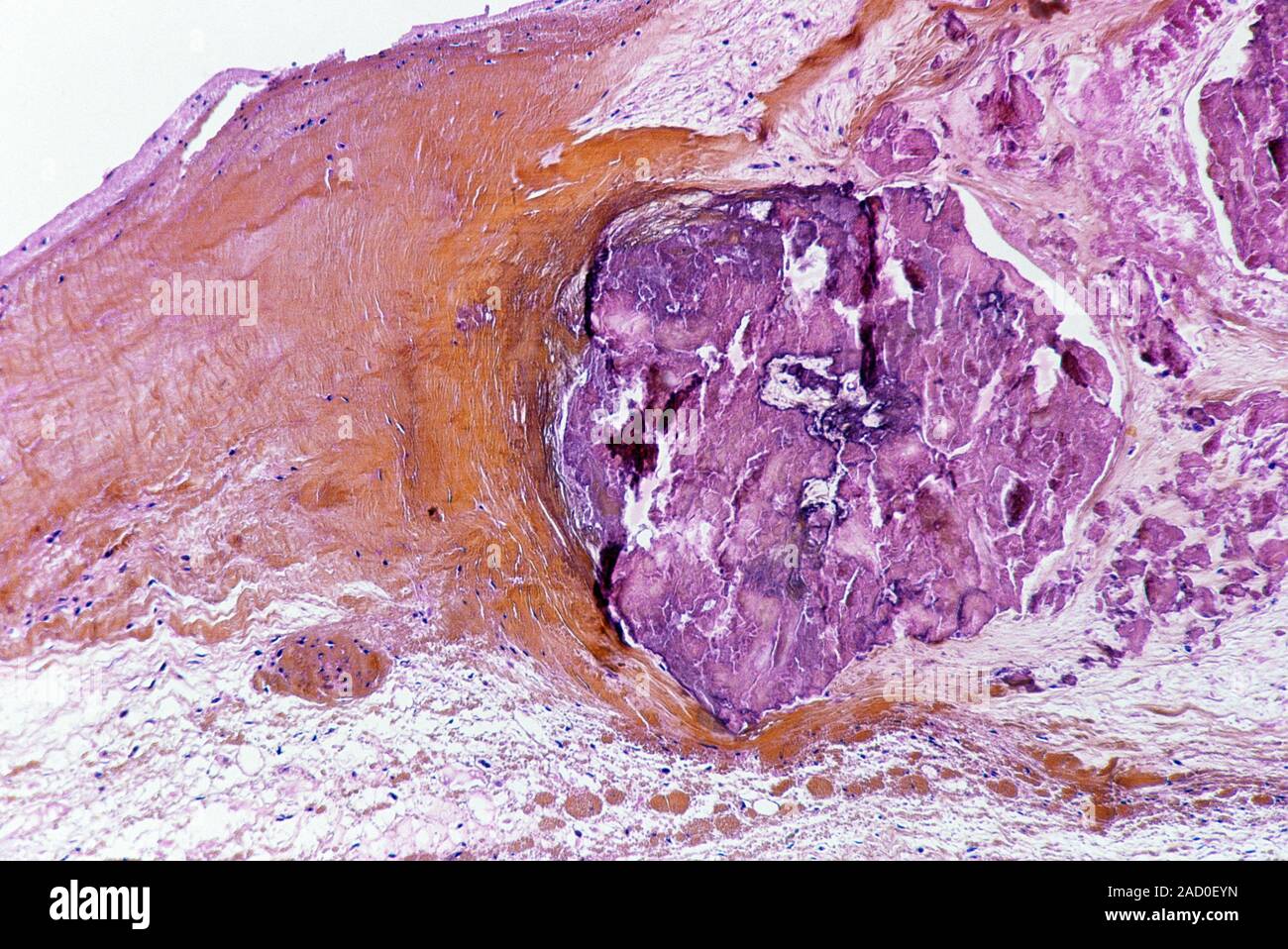 Infective endocarditis. Lightmicrograph of a section through the valve