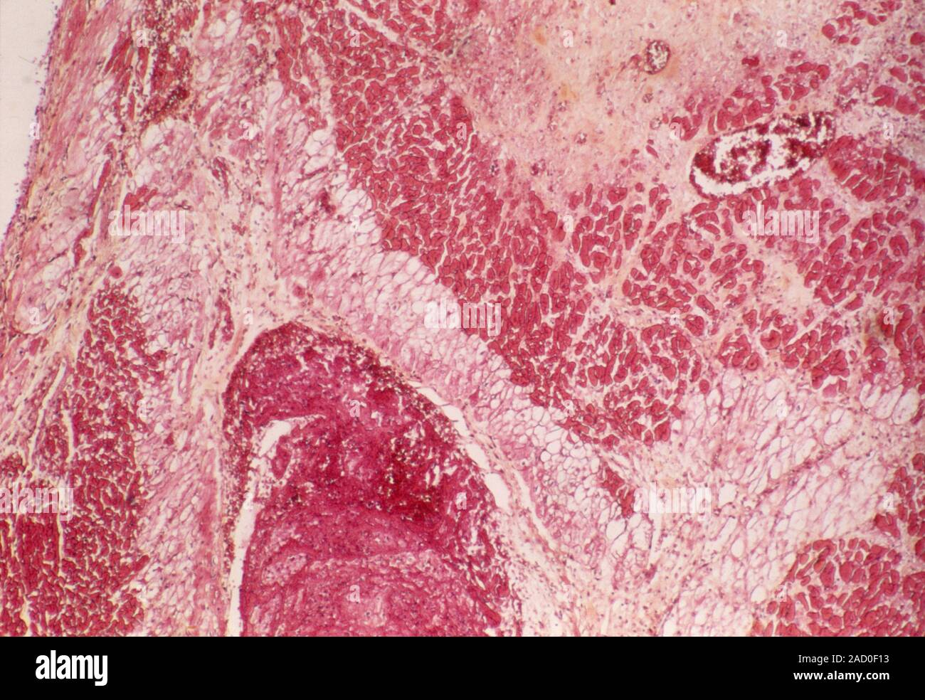 Heart after heart attack. Light micrograph of a section through a