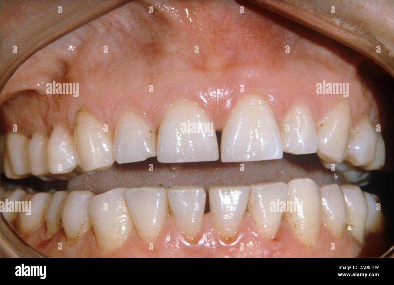 Dental abrasion. Closeup of the teeth of a patient, showing dental abrasion caused by bruxism