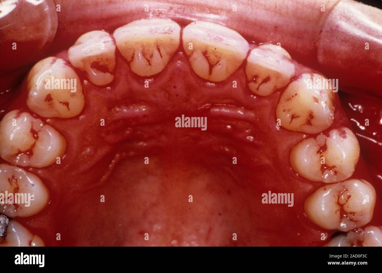 Dental plaque. Closeup of dental plaque on the teeth of a patient