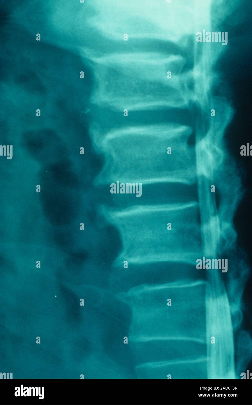 Lumbar spinal stenosis. Myelogram Xray of a spine affected by lumbar