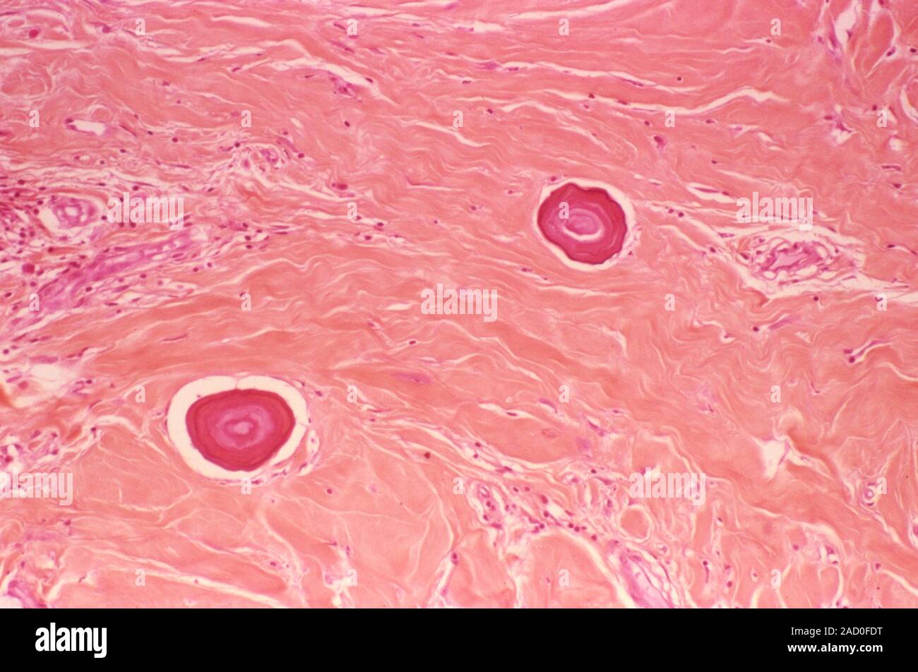 Juvenile fibroma. Light micrograph of a section through a juvenile ...