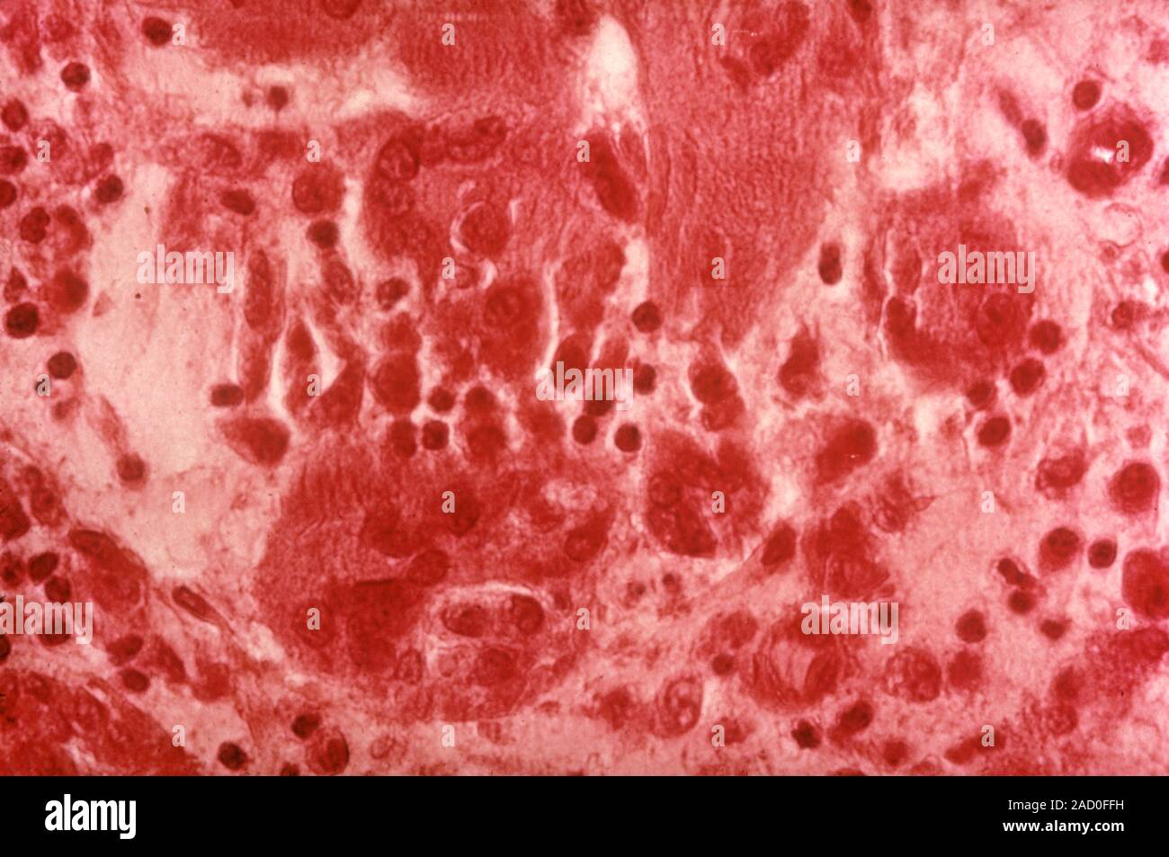 Granuloma Light Micrograph Of A Section Through A Granuloma Granulomas Are An Area Of 1828