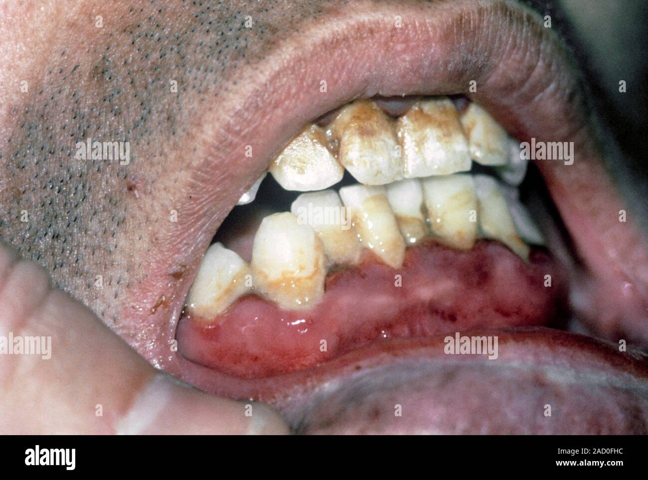 Oral bleeding in scurvy. Closeup of the mouth of a patient with scurvy