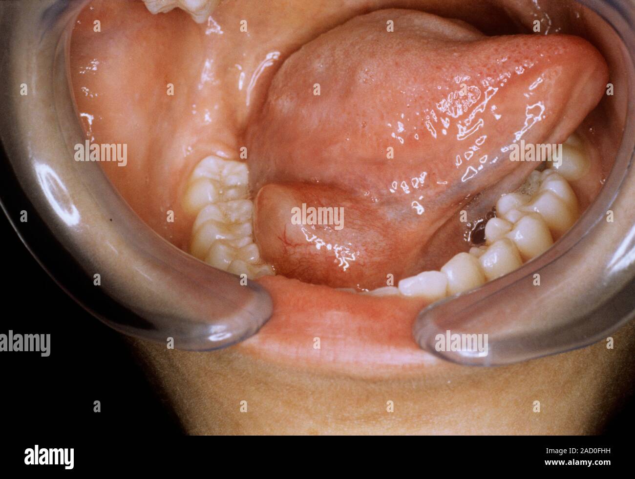 Ranula in a mouth. Close-up of a ranula (centre) in a person's mouth ...