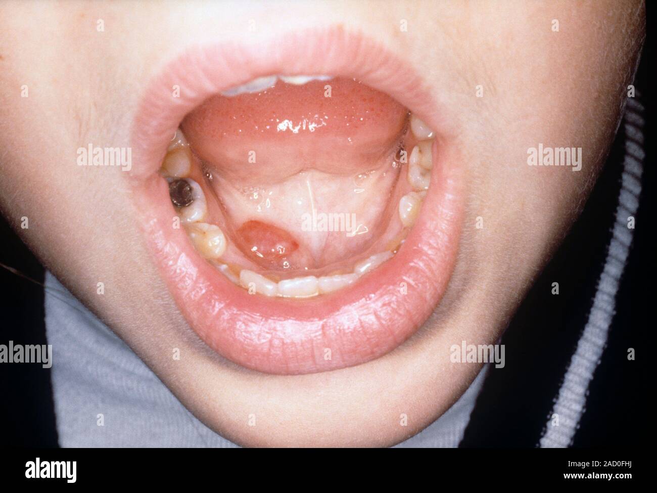 Pediatric Ranula Ranula in a mouth. Close-up of a ranula (centre) in a child's mouth ...