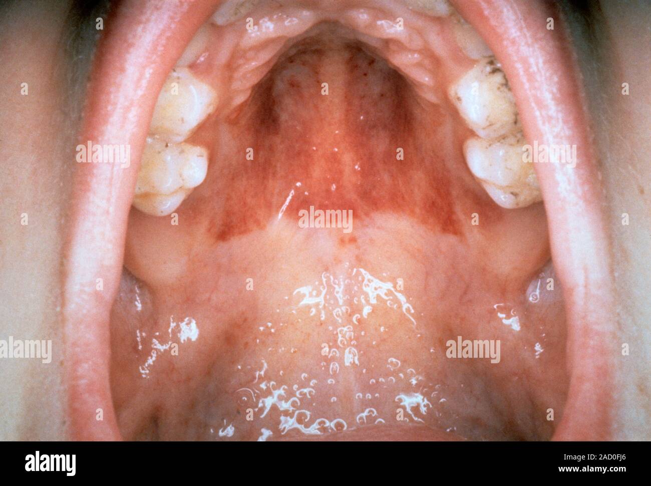 Oral bleeding in scurvy. Closeup of the mouth of a patient with scurvy