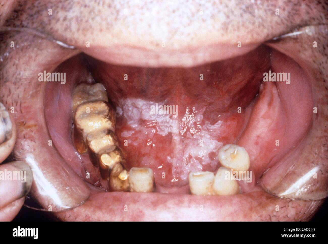 Leukoplakia of the mouth. Closeup of the mouth of a patient showing