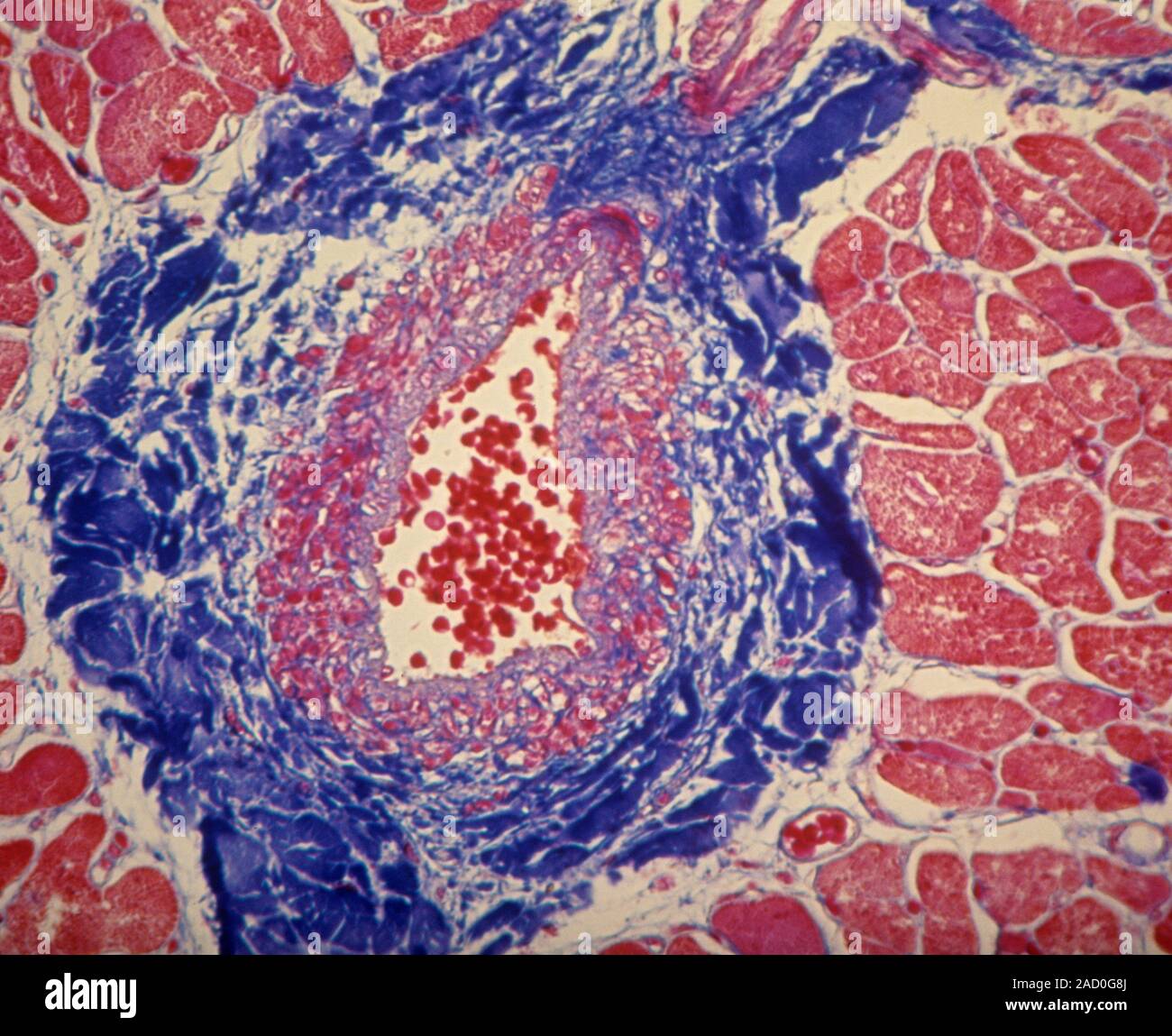 Coronary artery. Light micrograph of a cross-section of a normal human ...