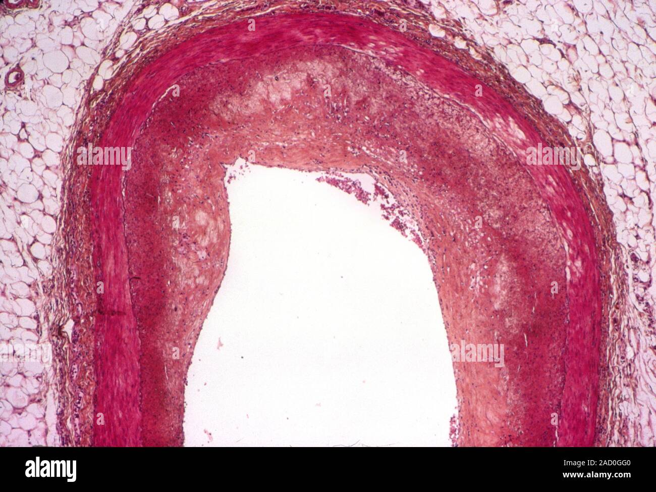 Atherosclerosis. Light micrograph of a section through part of a human