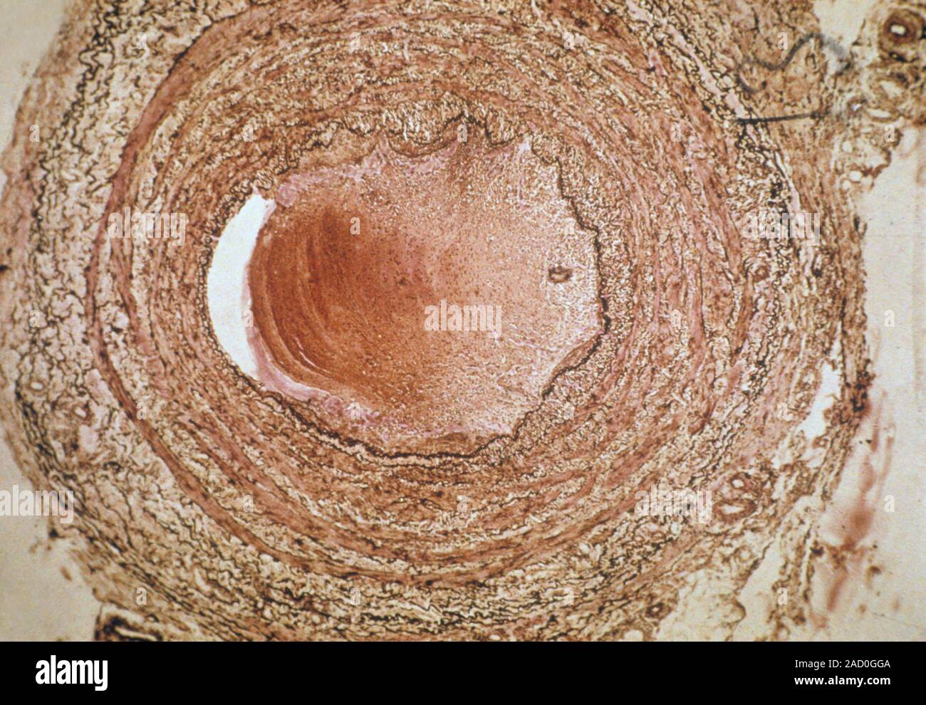 Buerger's disease. Light micrograph of a blood vessel in Buerger's