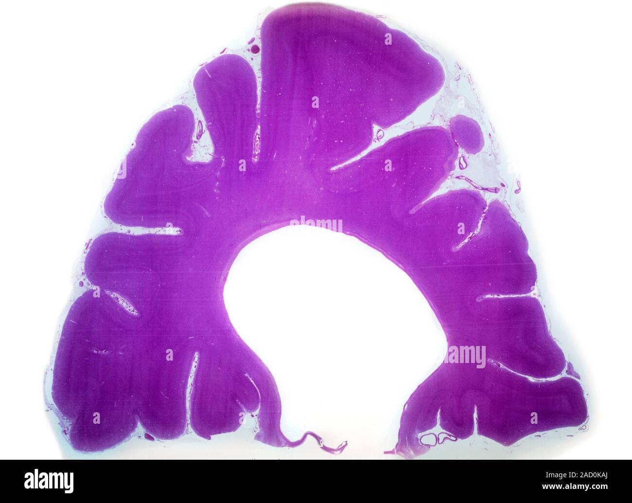 Alzheimer's brain. Light micrograph of a section through the frontal horn of the brain from a young person affected by Alzheimer's disease. Alzheimer' Stock Photo