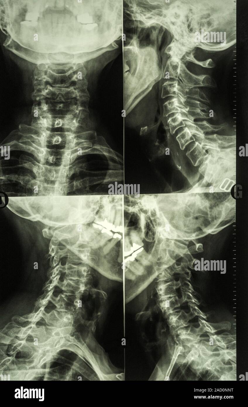 Diagnostic neck Xrays. Four Xrays of a human neck from different