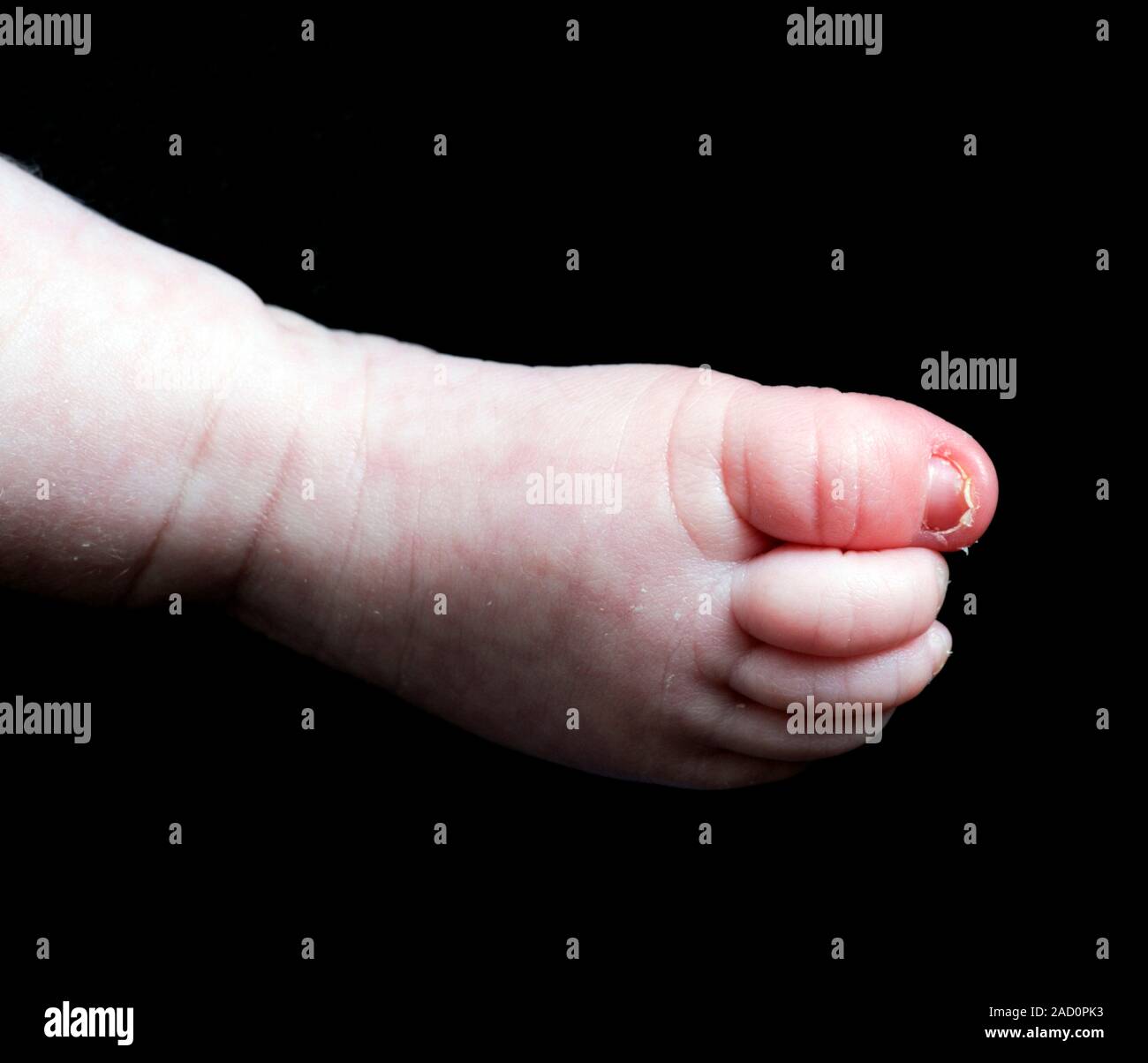 Not for use in Television Not for use in Television Swollen toe. Close-up of the foot of a baby girl with dactylitis (inflammation of fingers or toes) Stock Photo