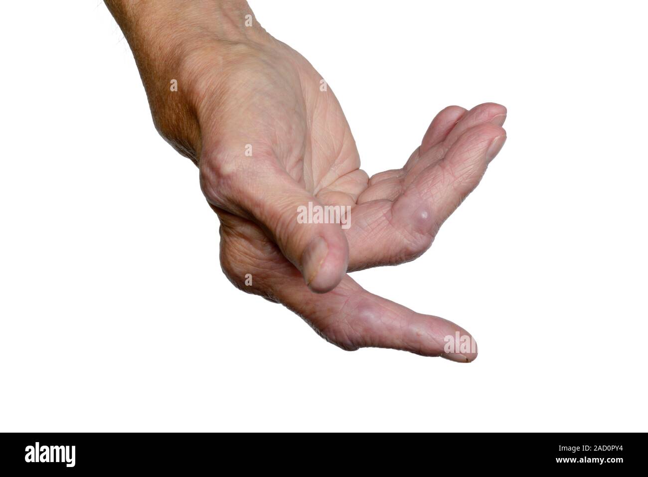 Not for use in Television Not for use in Television Rheumatoid ...