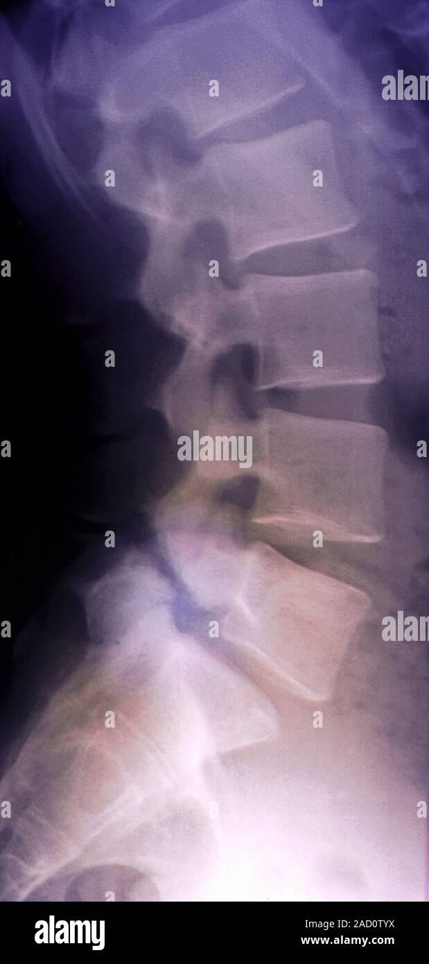 Listesis Spondylolisthesis. Coloured X-ray of a section through the lower back ...